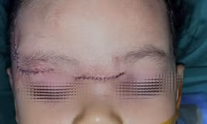 Bé gái 22 tháng tuổi bị chó cắn tổn thương nghiêm trọng vùng mặt