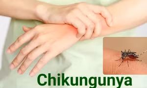 Bệnh Chikungunya đang diễn biến phức tạp, ai cần cẩn trọng?