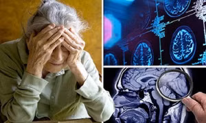 Hướng đi mới trong cuộc chiến chống bệnh Alzheimer