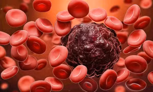Phát hiện protein mở đường điều trị ung thư máu ác tính