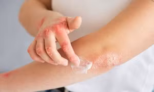 Những biện pháp tránh ngứa, dị ứng trong mùa mưa lũ