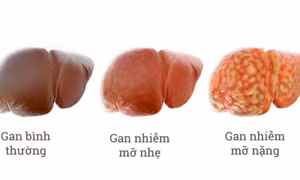 Ai có nguy cơ bị gan nhiễm mỡ?