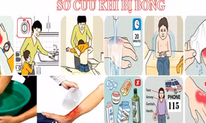 Bị bỏng có nên chườm đá, bôi kem đánh răng?
