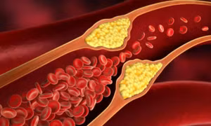 Giảm cholesterol tránh xơ vữa động mạch không cần dùng thuốc, cách nào?