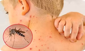 Bộ Y tế: Các tỉnh, thành tăng cường phòng chống sốt xuất huyết và dịch bệnh mùa hè
