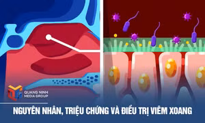 Nguyên nhân, triệu chứng và điều trị viêm xoang