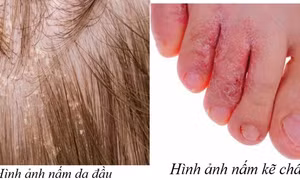Trời nồm ẩm dễ mắc nấm da, nhận biết thế nào?