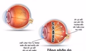 Thực phẩm tốt cho người bệnh tăng nhãn áp