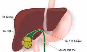 Thói quen ăn uống nào nguy cơ dẫn đến sỏi mật?