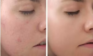 Những điều cần biết về peel da làm trắng