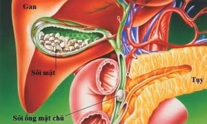5 triệu chứng cảnh báo sỏi túi mật bạn cần biết