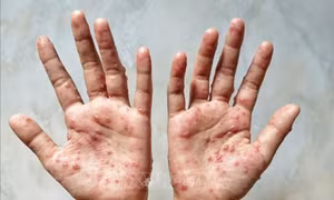 Phát hiện trường hợp mắc bệnh đậu mùa khỉ đầu tiên tại Lào