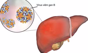 Cảnh giác với suy gan cấp