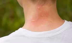 Phòng ngừa và xử trí đúng cách côn trùng đốt khi du xuân tránh biến chứng nguy hiểm