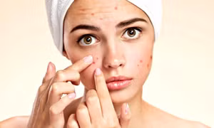 Cách xử lý mụn trứng cá, phục hồi làn da khỏe mạnh sau mụn