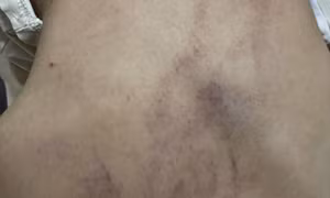 Bộ Y tế vào cuộc, trưng cầu giám định bé 4 tuổi bị cô giáo bạo hành