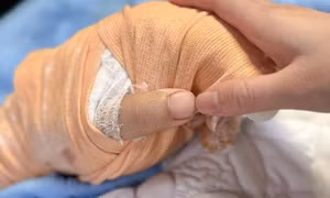 Nối lại thành công bàn tay bị chém lìa của nam TikToker có tiếng ở Thái Nguyên
