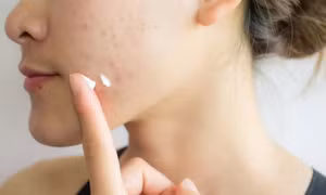 Da mụn nên trang điểm thế nào vừa che khuyết điểm vừa không gây bí da?
