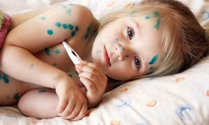 Chăm sóc trẻ bị thủy đậu: Tuyệt đối không được làm vỡ mụn nước!