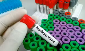 Bùng phát virus Marburg gây tử vong cao ở Tanzania