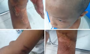 Bé trai 6 tuổi mang nhiều thương tích, nghi bị bạo hành
