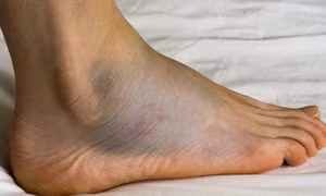 Những dấu hiệu cảnh báo suy tim dễ bị bỏ qua