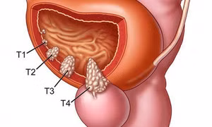Liệu pháp mới điều trị ung thư bàng quang