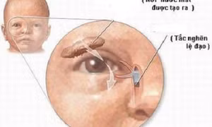 Giúp mẹ nhận biết tắc tuyến lệ ở trẻ sơ sinh sớm nhất