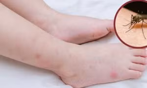 Cách xử lý vết muỗi đốt