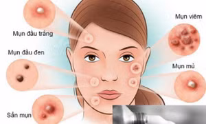 Thêm một lựa chọn điều trị cho người bị mụn trứng cá