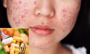 Sử dụng thuốc kháng sinh lâu dài trị mụn trứng cá có thúc đẩy kháng thuốc?