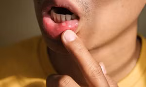 Phương pháp xử lý nhanh nhiệt miệng
