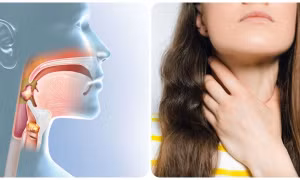 Dấu hiệu ung thư vòm họng giai đoạn đầu