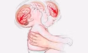 Bé 4 tháng tuổi bị xuất huyết não nghi do bế xốc, rung lắc