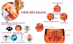 Sáu thói quen xấu khiến nhiều người mắc viêm mũi xoang