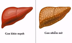 4 dấu hiệu cảnh báo mắc bệnh gan nhiễm mỡ dễ nhận biết