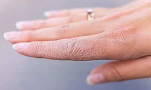 Da khô nẻ 'như da rắn' vào mùa đông, kiểm soát thế nào?