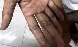 Đồng Nai xuất hiện ca đậu mùa khỉ chưa rõ nguồn lây, ngành y tế khẩn trương truy vết