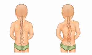 Làm gì khi trẻ gù lưng, cong vẹo cột sống do dùng điện thoại quá nhiều?