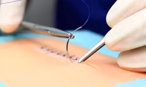 Đột phá phẫu thuật an toàn nhờ nút thắt "lập trình sẵn"
