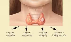  Ung thư tuyến giáp: Sự phát triển của khối u và khả năng di căn