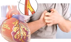 Cảnh báo dấu hiệu bị nhồi máu cơ tim trong mùa lạnh