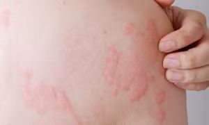 Cách xử lý với bệnh mề đay do lạnh