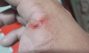 Chồng cắn vợ chảy máu, biểu hiện nghi bệnh dại sau khi bị chó cắn