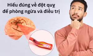 Những lầm tưởng về đột quỵ khiến bạn bỏ qua cơ hội vàng