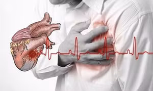 Ngoài cơn đau thắt ngực, 4 dấu hiệu cảnh báo nhồi máu cơ tim cấp ai cũng nên biết