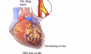 4 yếu tố gây nhồi máu cơ tim cấp cần lưu ý