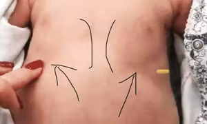 Nhận biết bé bị viêm phổi nặng, chỉ cần thấy dấu hiệu quan trọng này