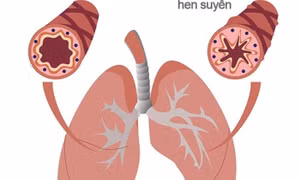 3 lưu ý kiểm soát hen người bệnh cần biết