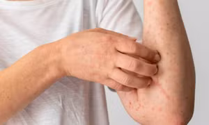 Thời tiết thay đổi khiến nhiều người tái phát viêm da cơ địa, bác sĩ khuyến cáo cách xử lý